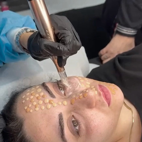 total bb glow e microneedling
