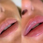Trattamento volume labbra