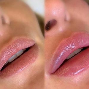 Trattamento volume labbra