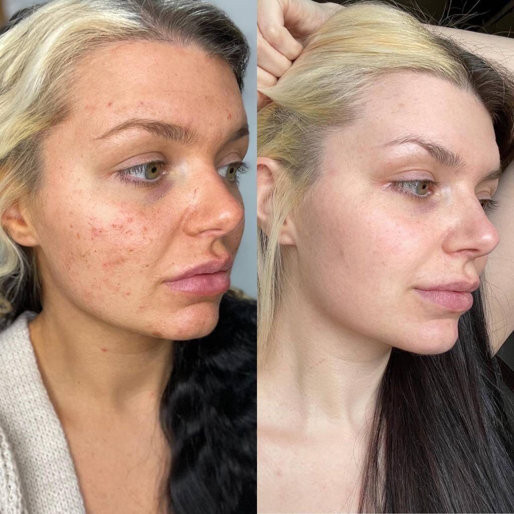 PHOTO-2023-12-27-16-47-37 dermaplaning